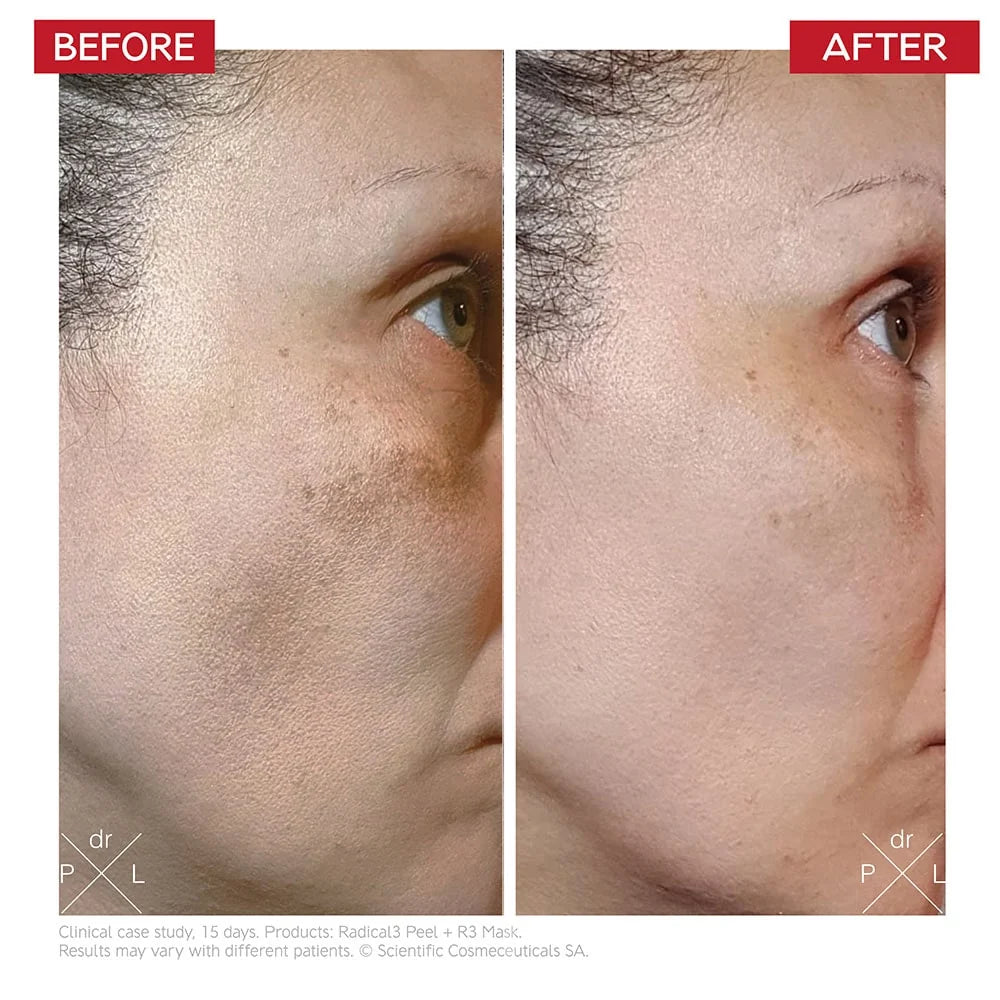 Dr. LEVY Switzerland Radical3 Reboot Pro Peel