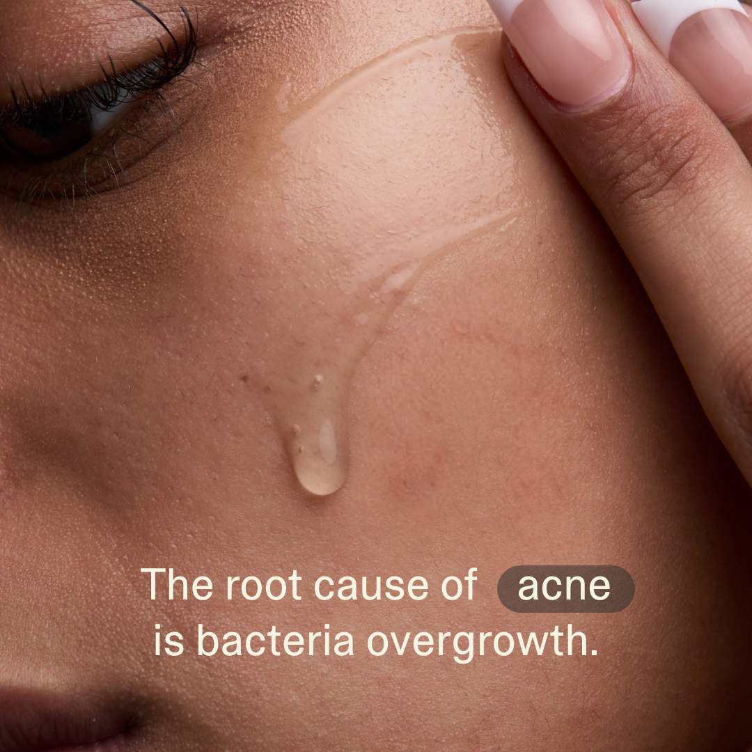 Acne Phage System
