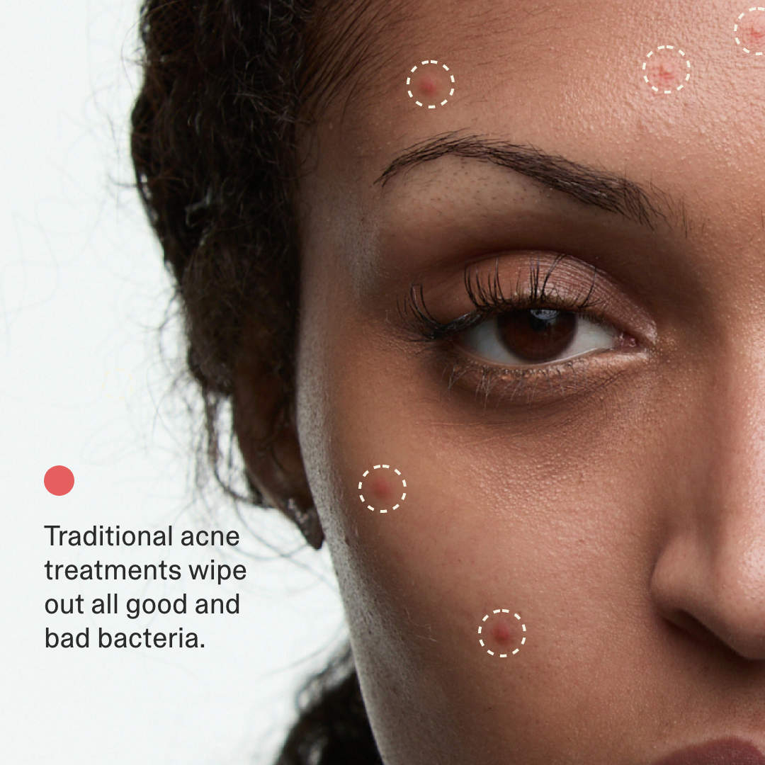 Acne Phage System